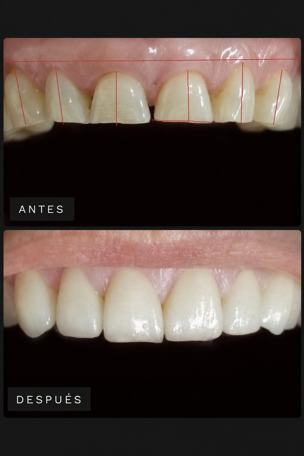 Caso diseño de sonrisa